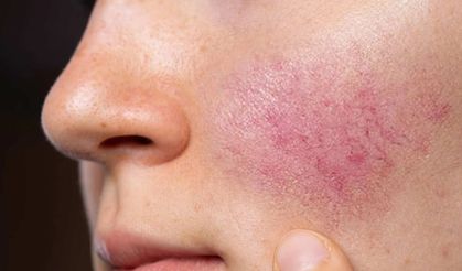 Gül hastalığı ihmal edilmemeli